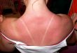 How to Treat Sun Poisoning: Know its Causes, Prevention, and Home Remedies